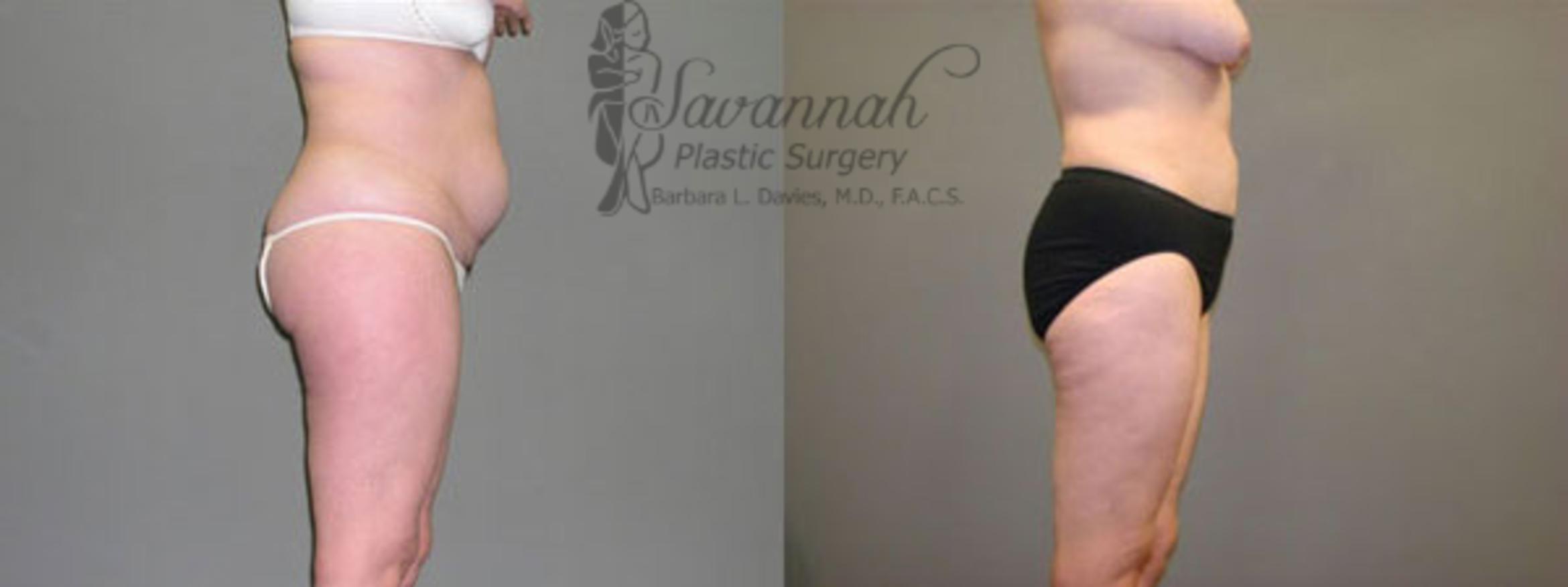 Before & After Liposuction Case 58 View 2 View in Savannah, Georgia