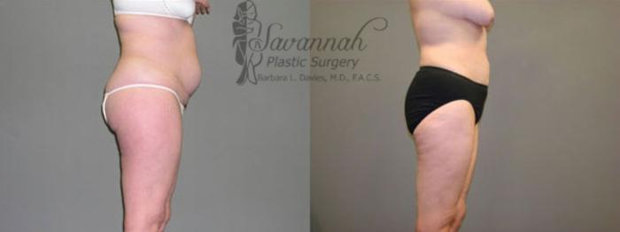 Before & After Liposuction Case 58 View 2 View in Savannah, Georgia