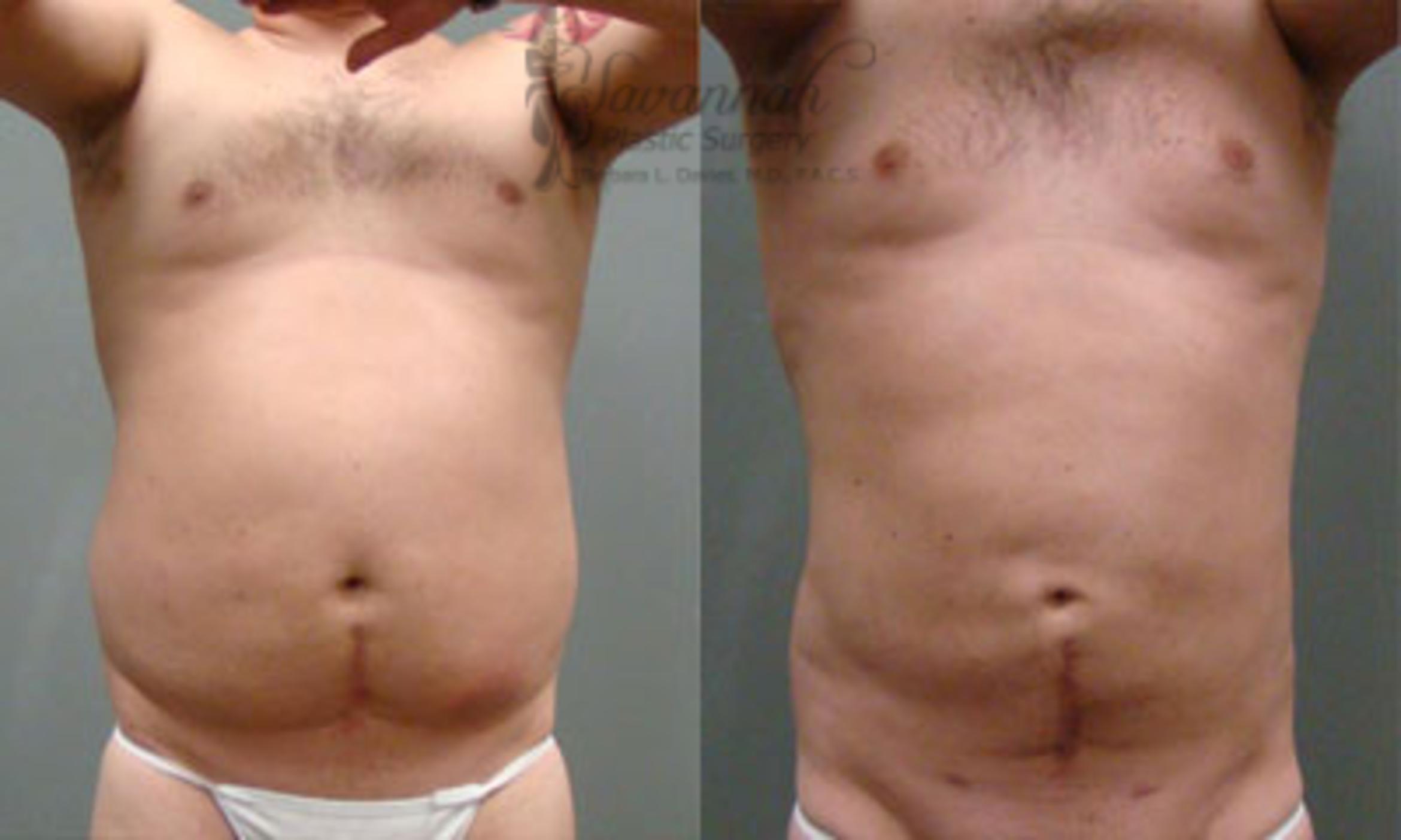 Before & After Liposuction Case 59 View 1 View in Savannah, Georgia