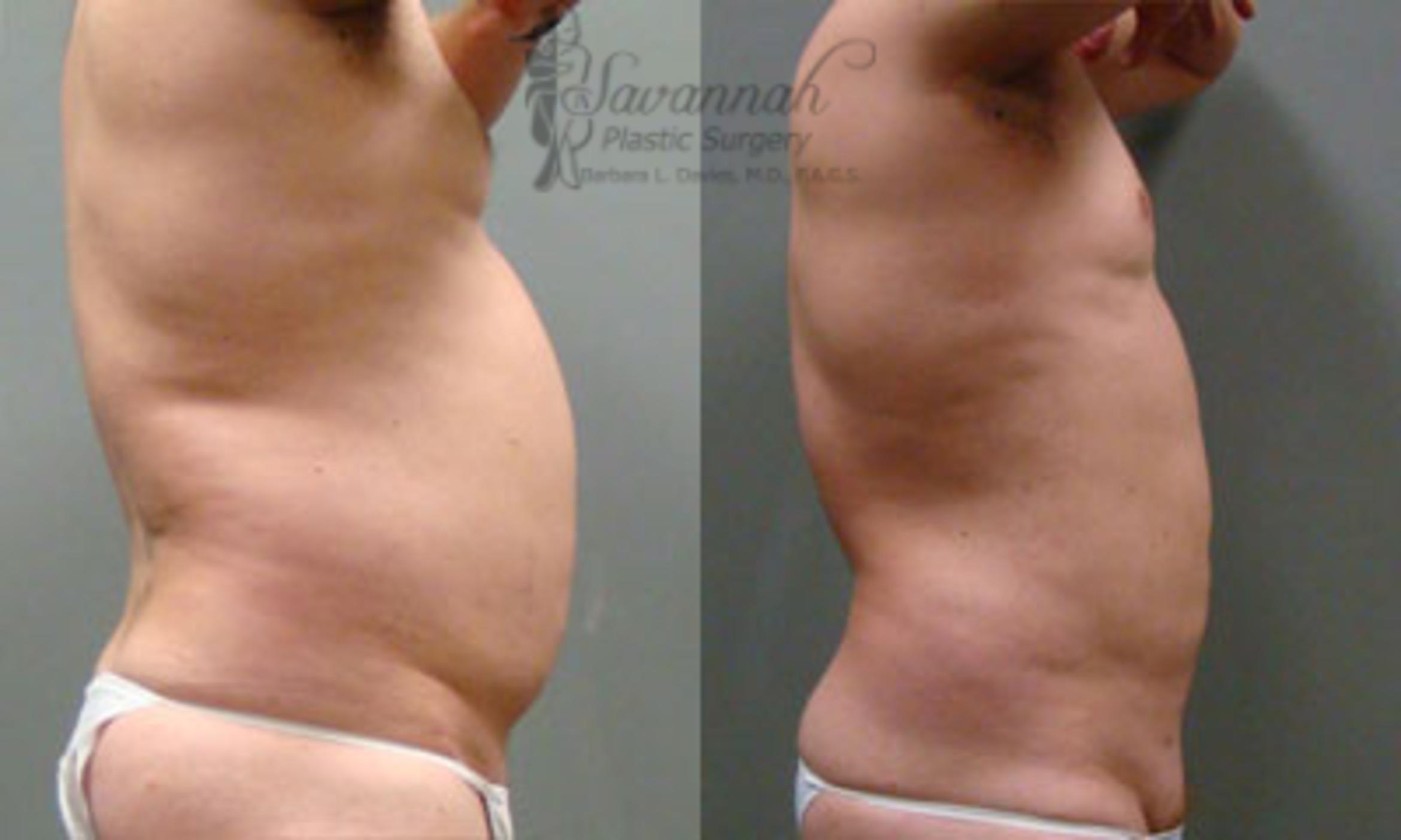 Before & After Liposuction Case 59 View 2 View in Savannah, Georgia