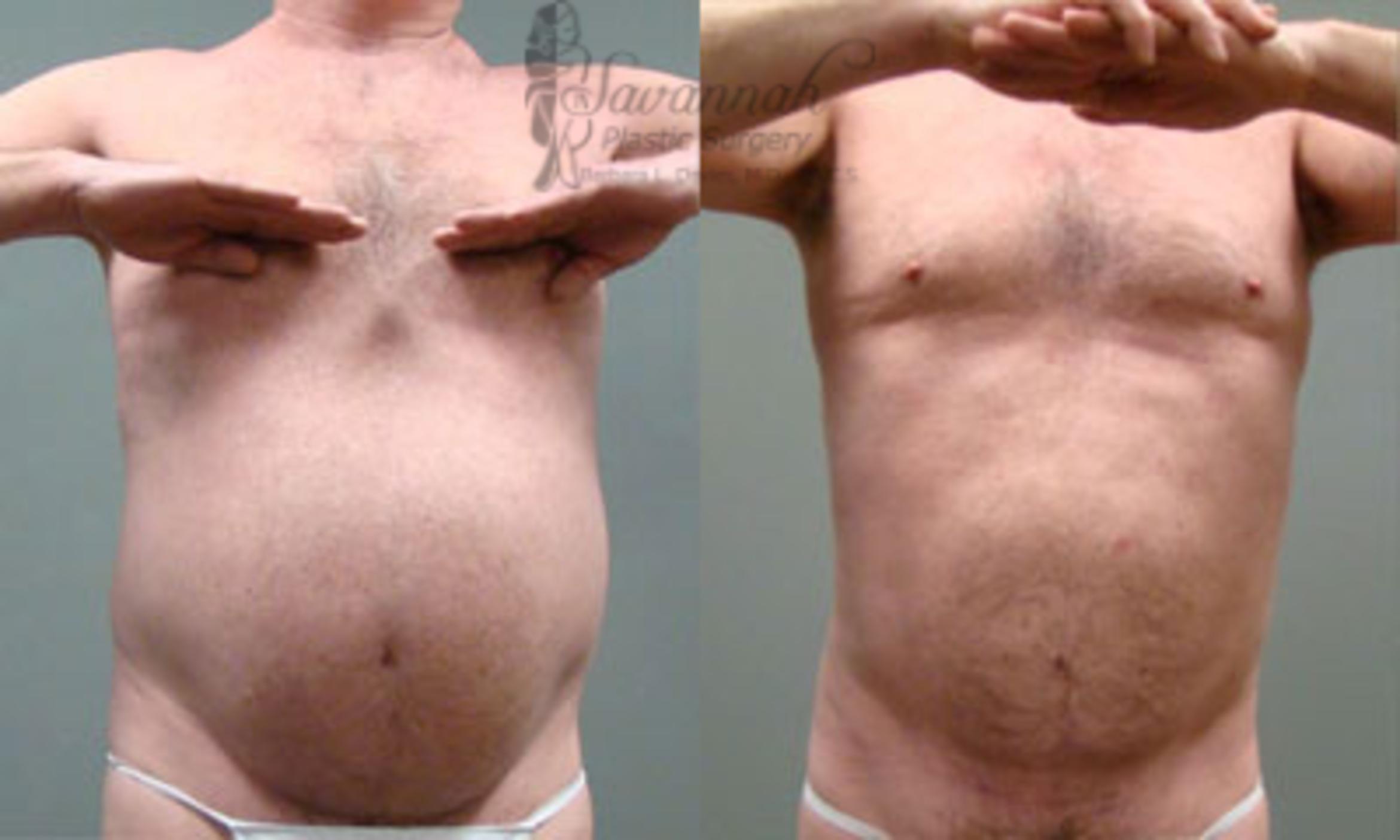 Before & After Liposuction Case 60 View 1 View in Savannah, Georgia