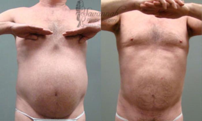 Before & After Liposuction Case 60 View 1 View in Savannah, Georgia