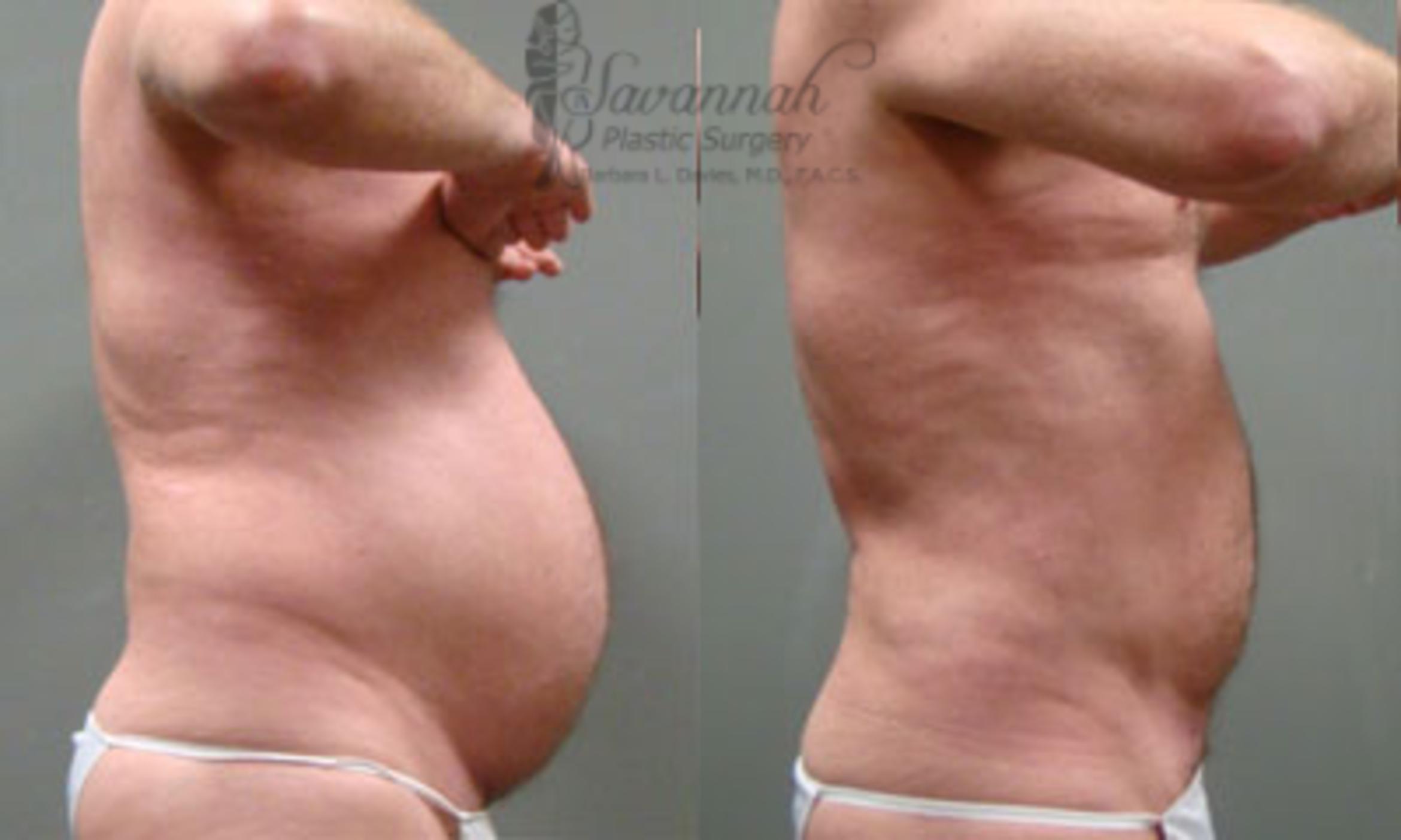 Before & After Liposuction Case 60 View 2 View in Savannah, Georgia