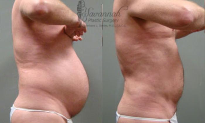 Before & After Liposuction Case 60 View 2 View in Savannah, Georgia