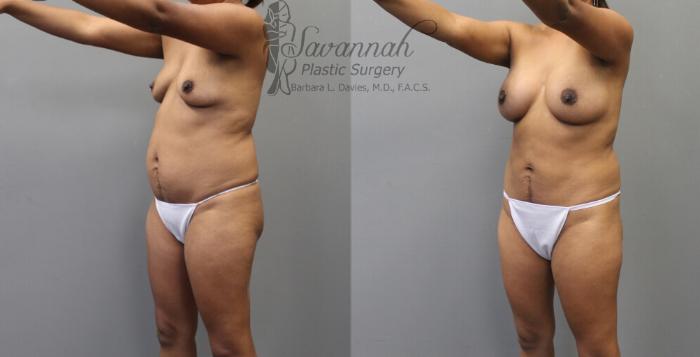 Before & After Mommy Makeover Case 28 View 2 View in Savannah, Georgia