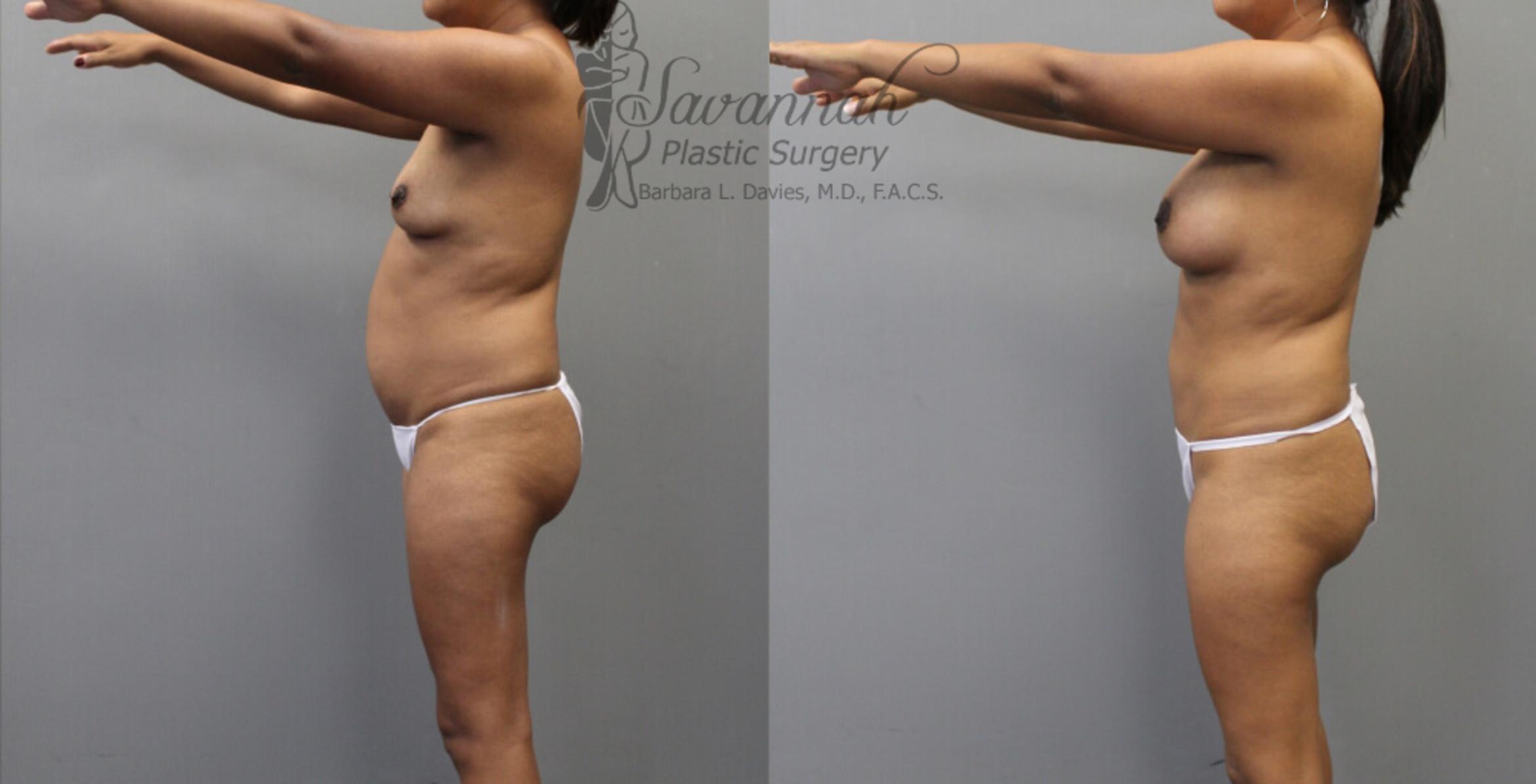 Before & After Mommy Makeover Case 28 View 3 View in Savannah, Georgia