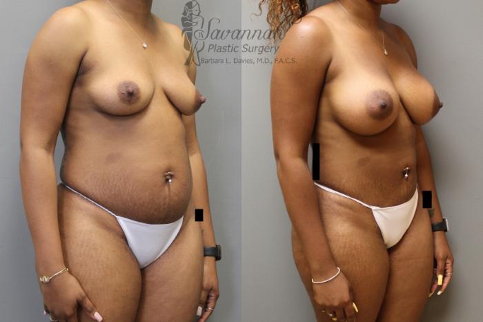 Before & After Mommy Makeover Case 29 View 2 View in Savannah, Georgia