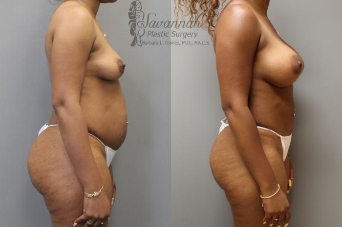 Before & After Mommy Makeover Case 29 View 3 View in Savannah, Georgia