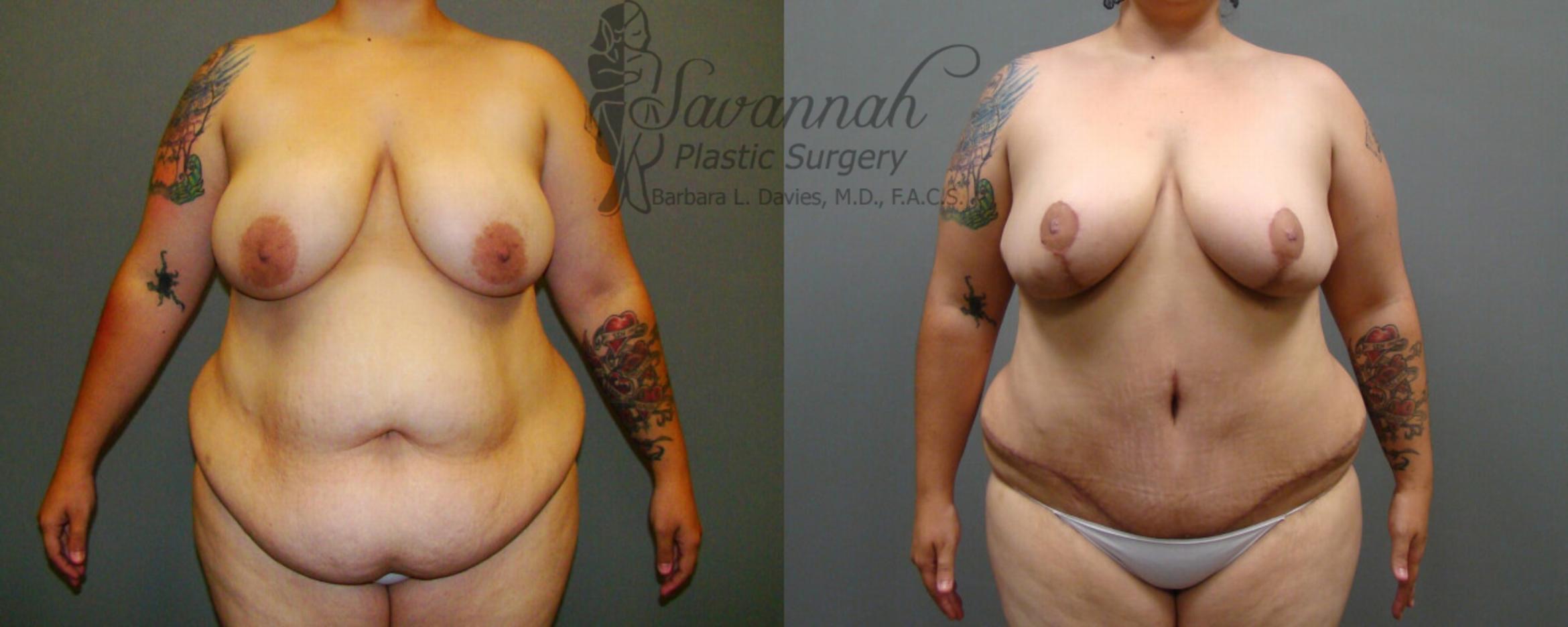 Before & After Tummy Tuck Case 22 View 1 View in Savannah, Georgia