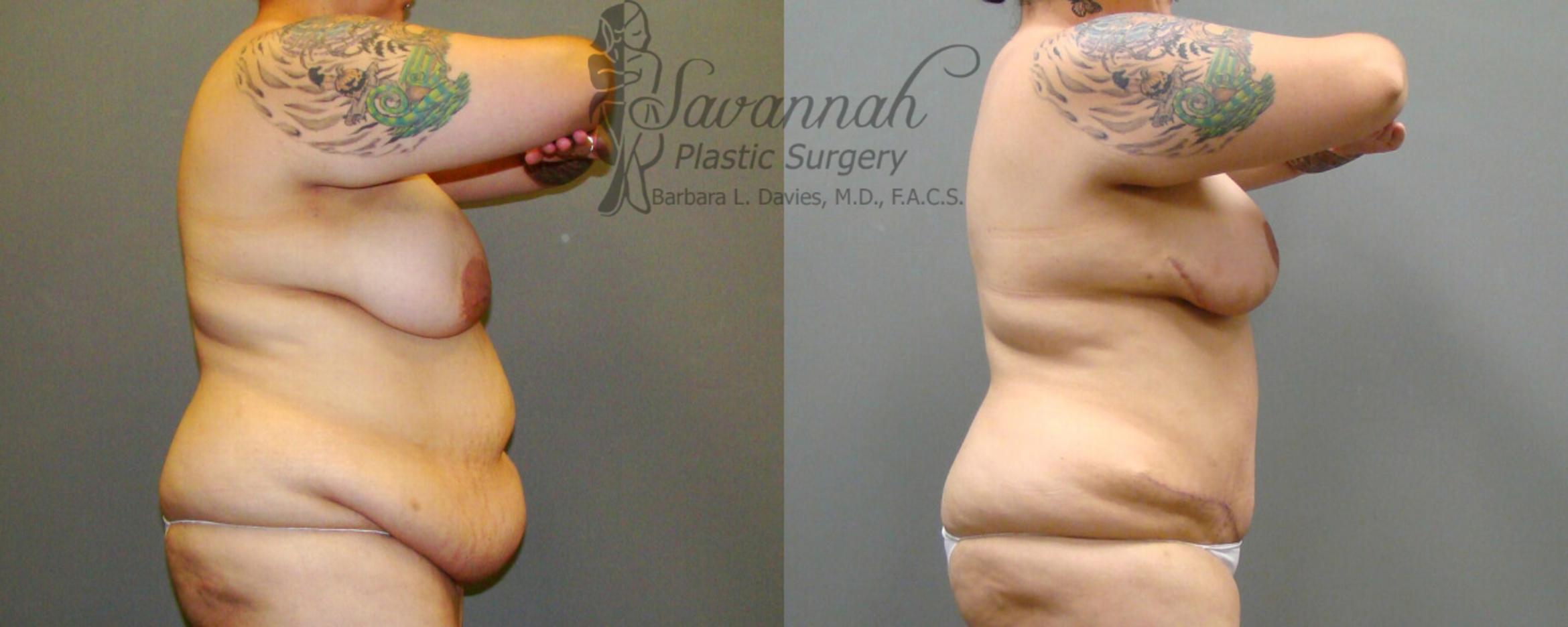 Before & After Tummy Tuck Case 22 View 2 View in Savannah, Georgia