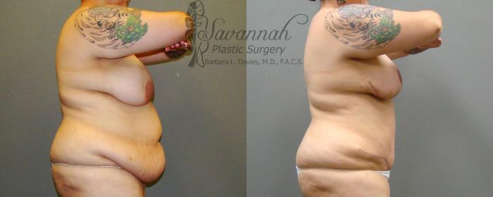 Before & After Tummy Tuck Case 22 View 2 View in Savannah, Georgia