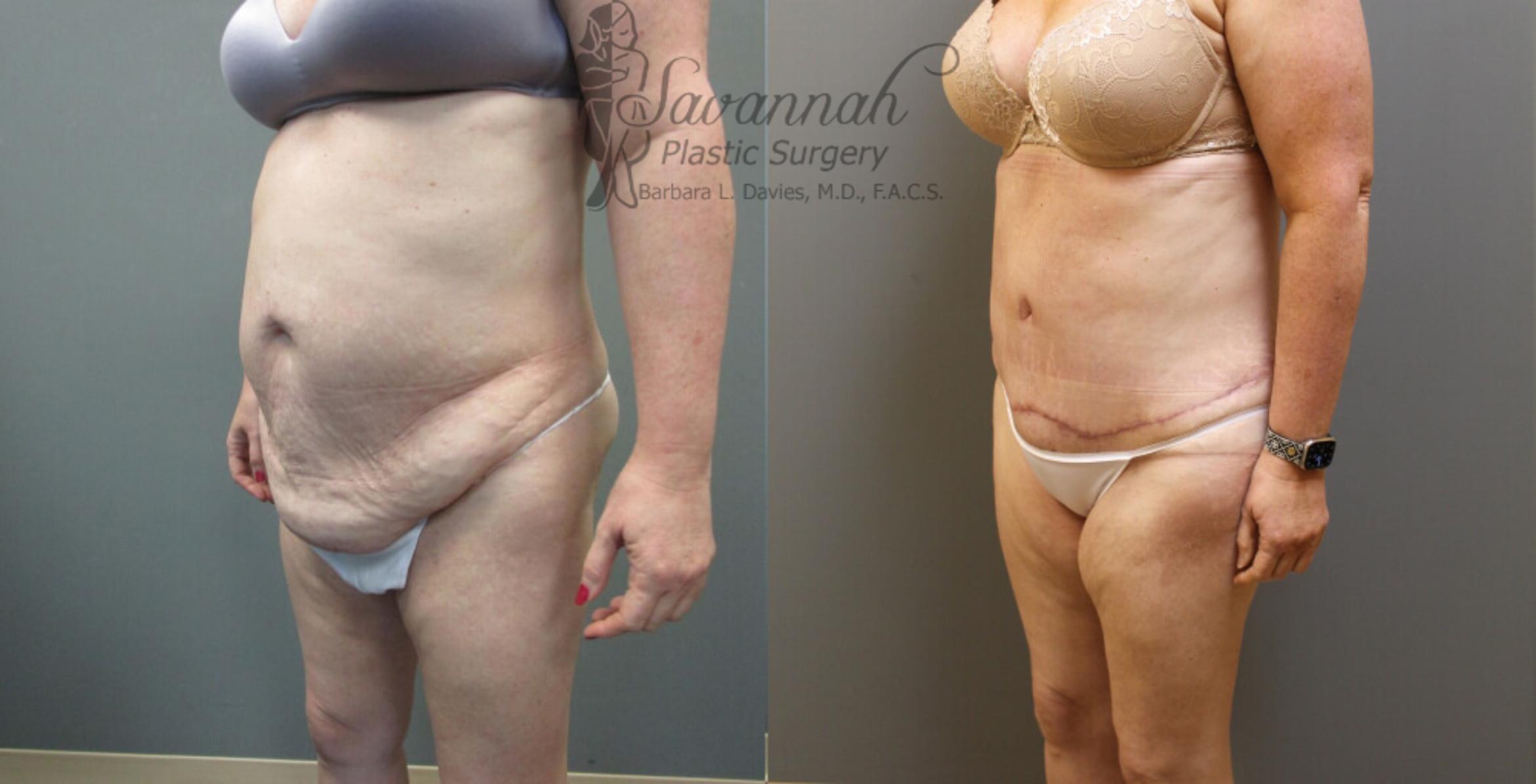 Before & After Tummy Tuck Case 31 View 2 View in Savannah, Georgia