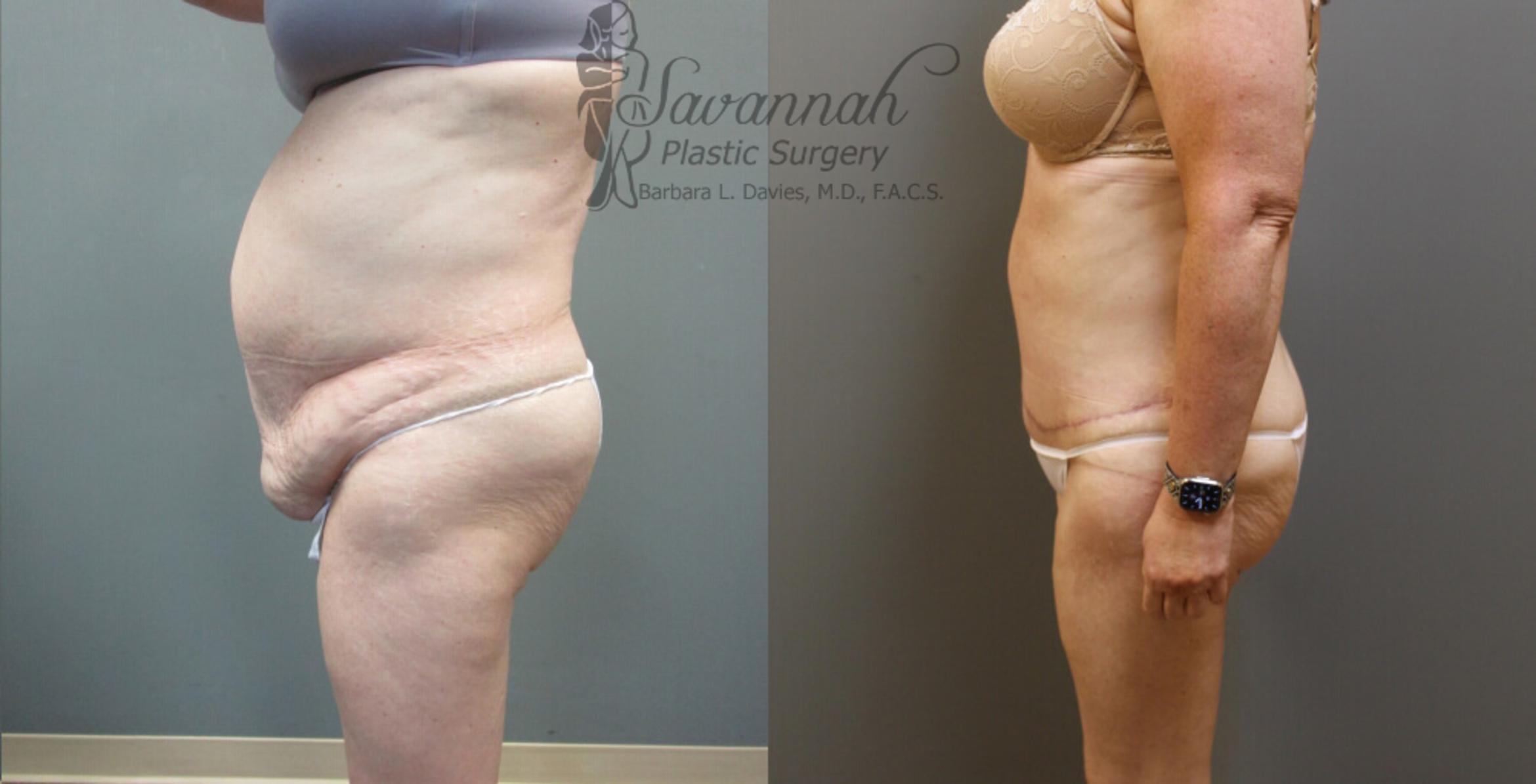Before & After Tummy Tuck Case 31 View 3 View in Savannah, Georgia