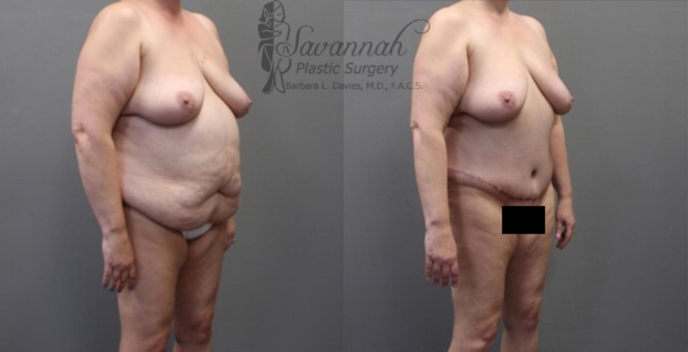Before & After Tummy Tuck Case 32 View 2 View in Savannah, Georgia