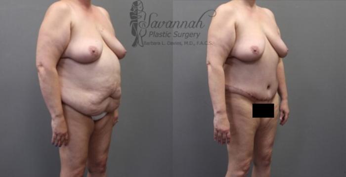 Before & After Tummy Tuck Case 32 View 2 View in Savannah, Georgia
