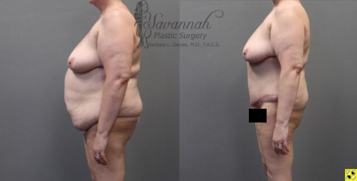 Before & After Tummy Tuck Case 32 View 3 View in Savannah, Georgia