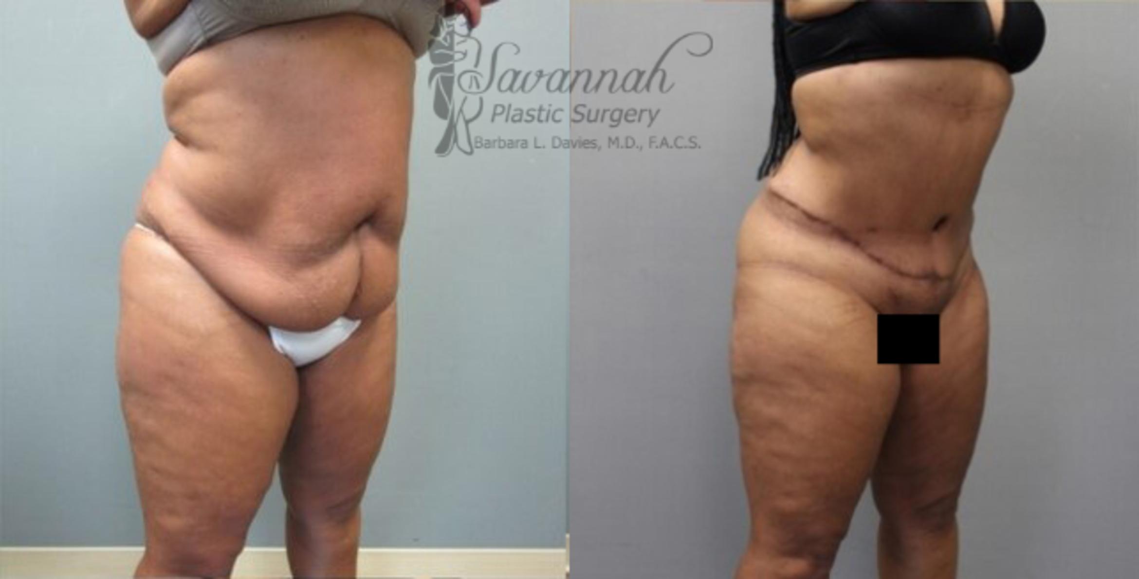 Before & After Tummy Tuck Case 33 View 2 View in Savannah, Georgia
