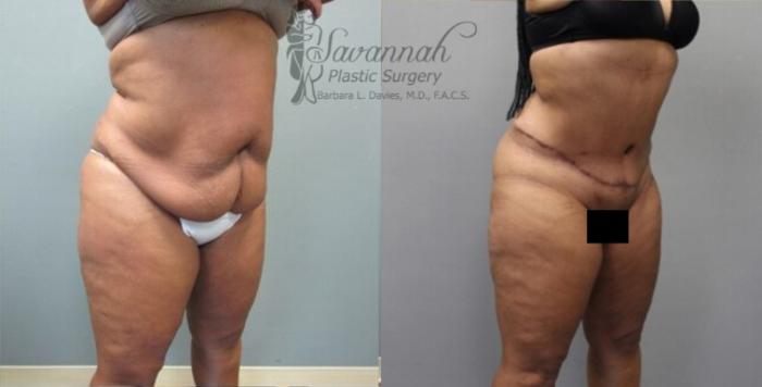 Before & After Tummy Tuck Case 33 View 2 View in Savannah, Georgia
