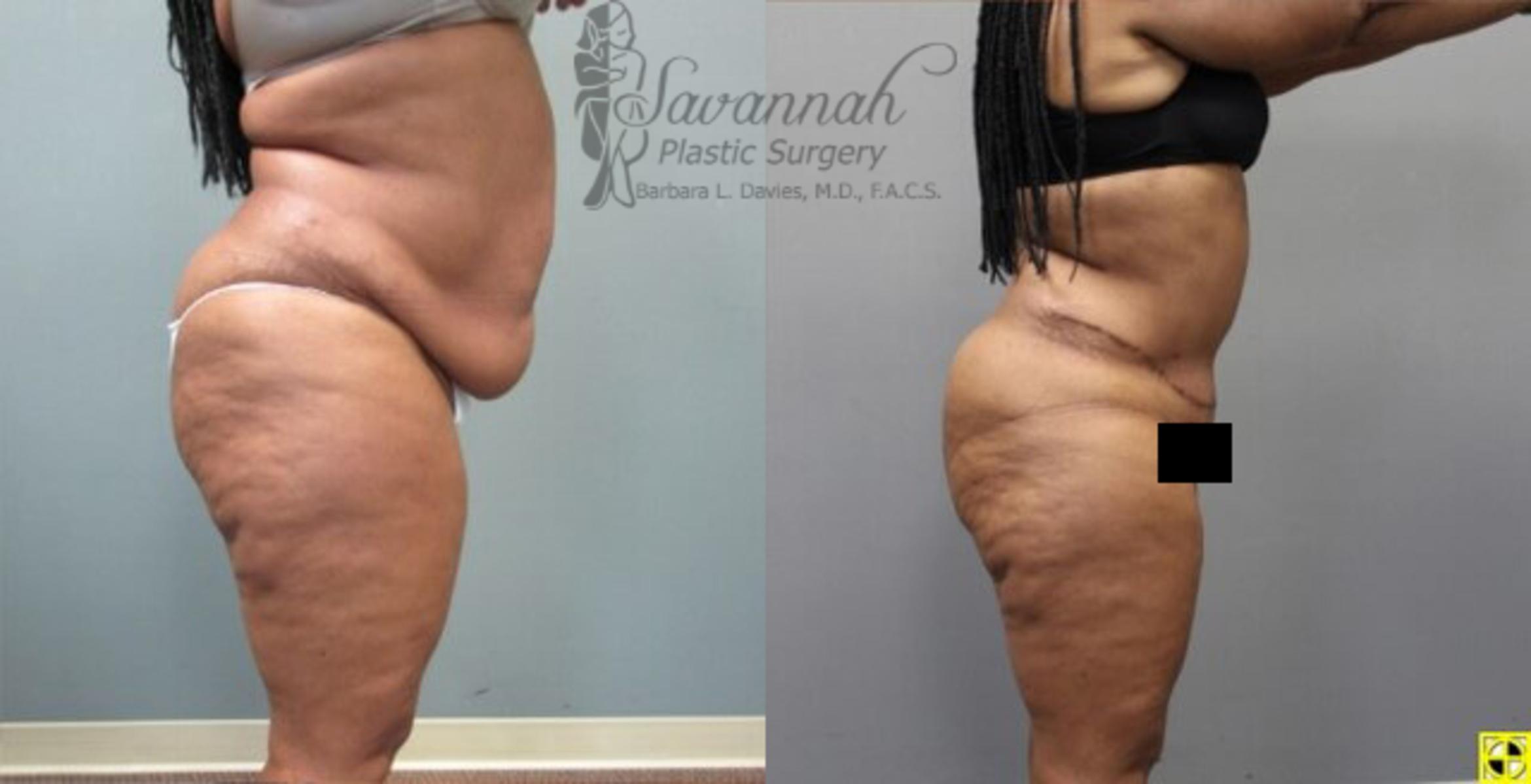 Before & After Tummy Tuck Case 33 View 3 View in Savannah, Georgia