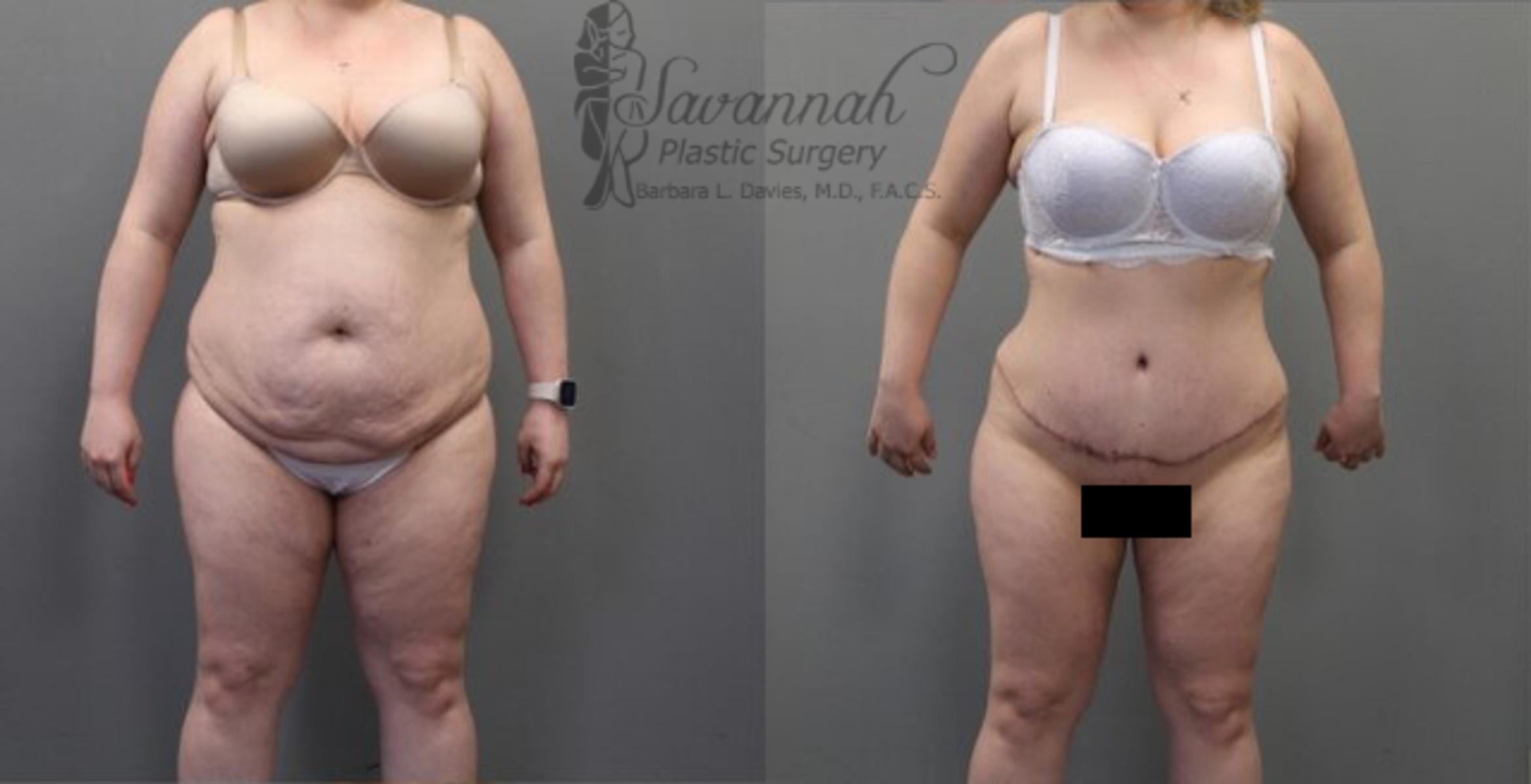 Before & After Tummy Tuck Case 34 View 1 View in Savannah, Georgia