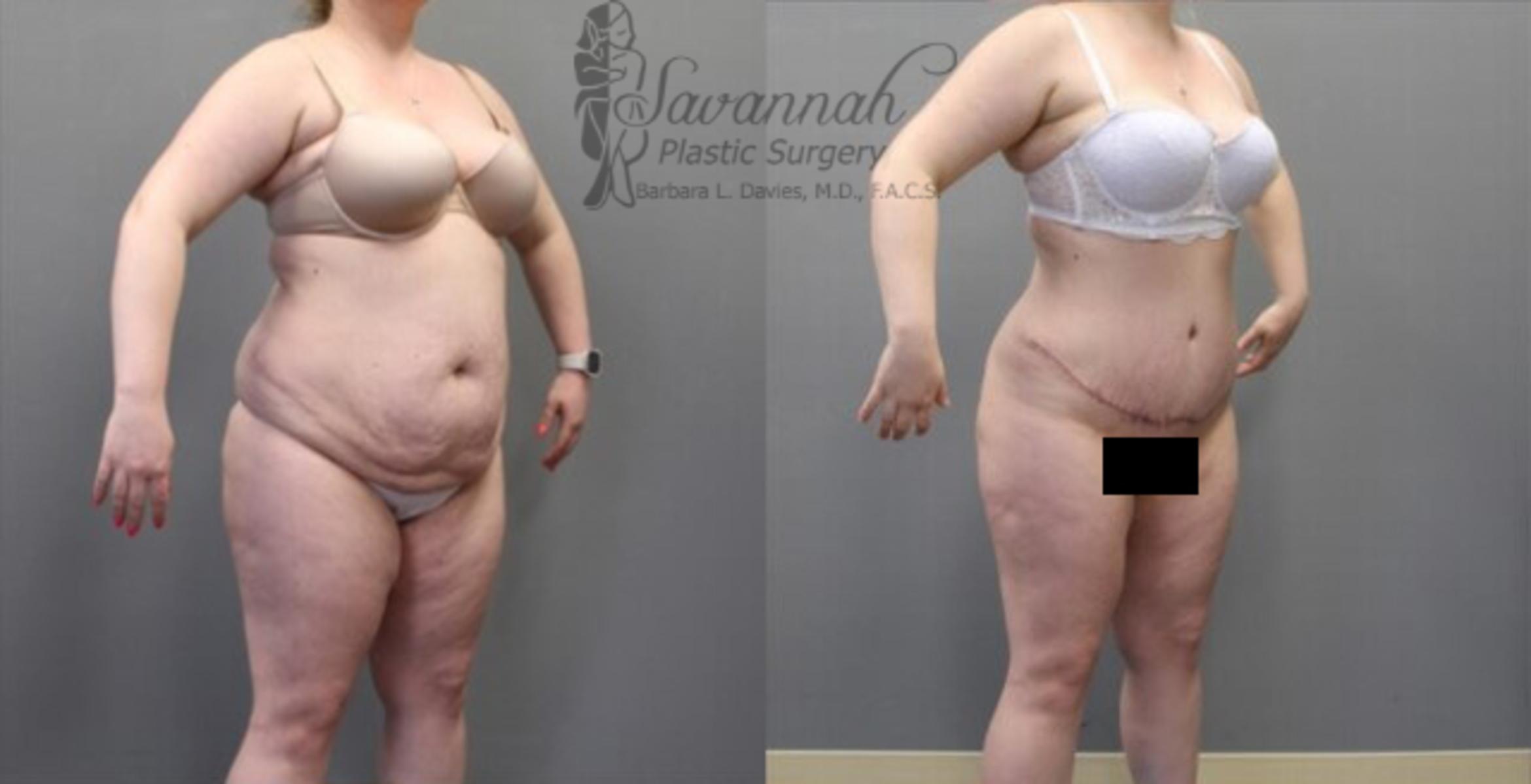 Before & After Tummy Tuck Case 34 View 2 View in Savannah, Georgia