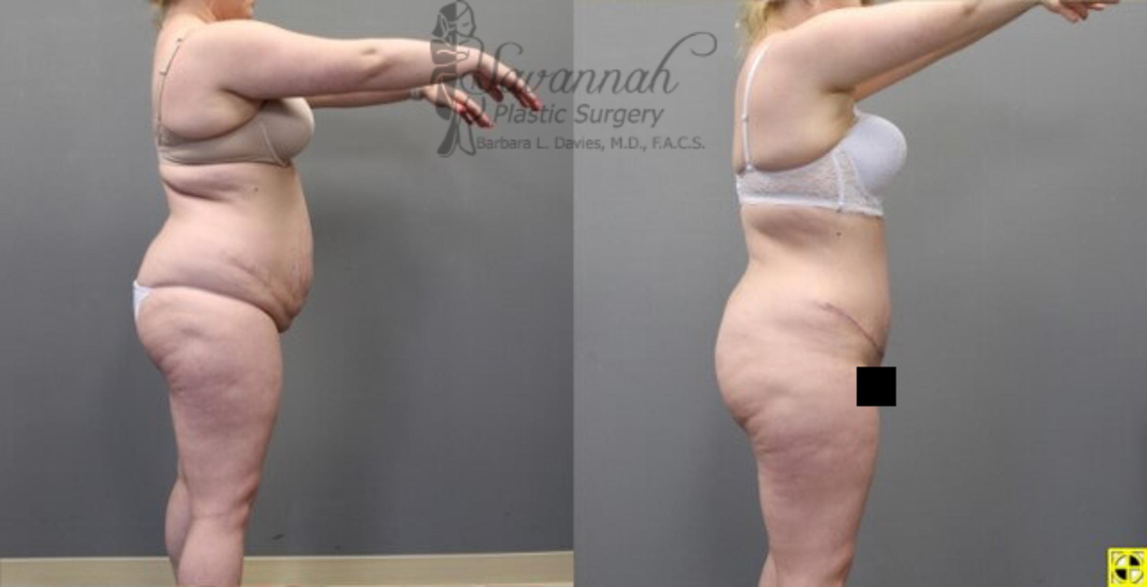 Before & After Tummy Tuck Case 34 View 3 View in Savannah, Georgia