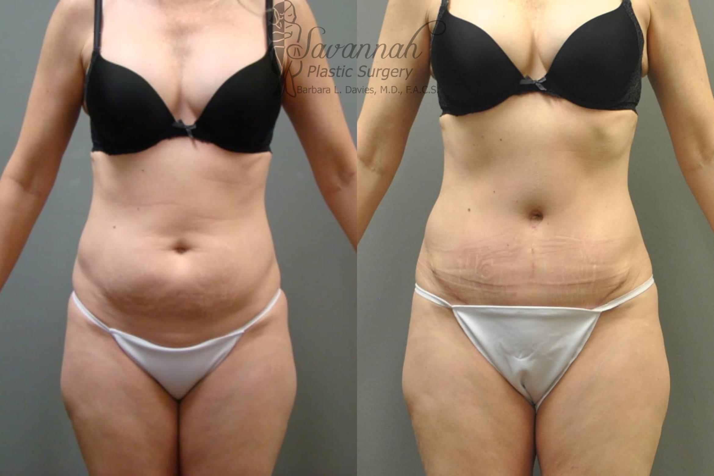 Before & After Tummy Tuck Case 36 View 1 View in Savannah, Georgia