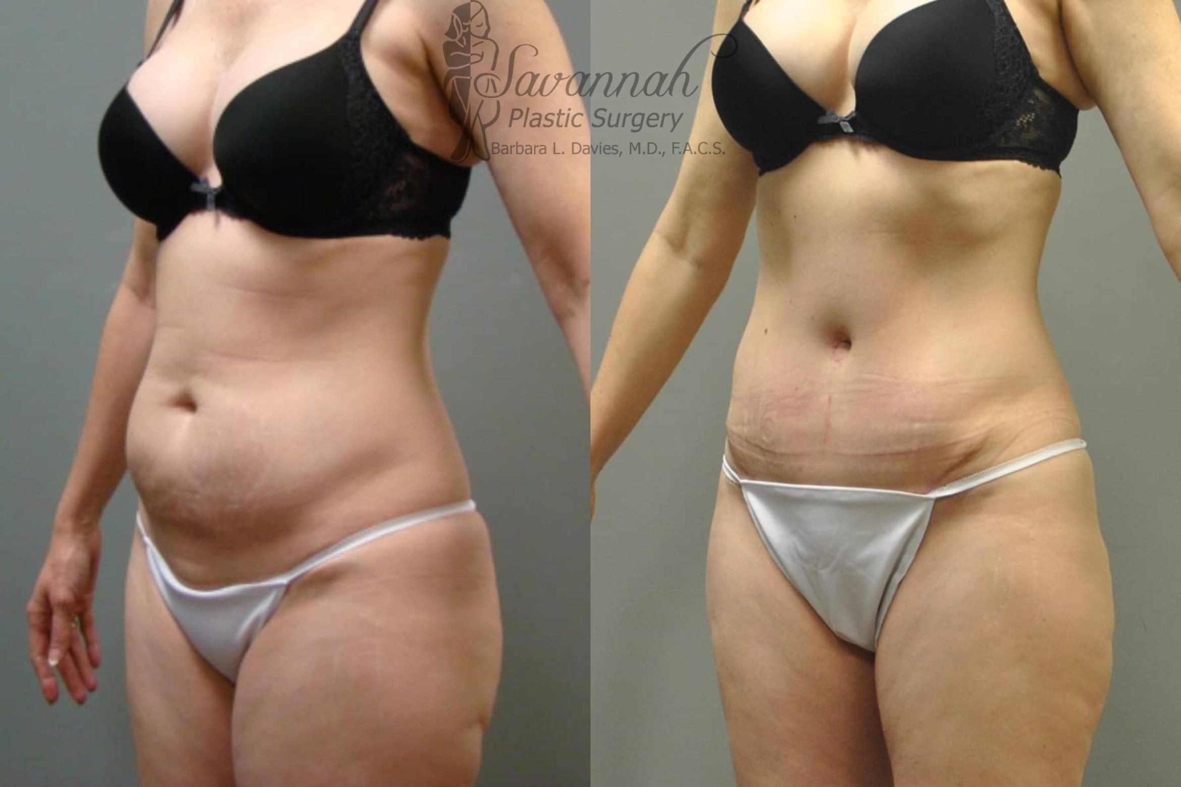Before & After Tummy Tuck Case 36 View 2 View in Savannah, Georgia