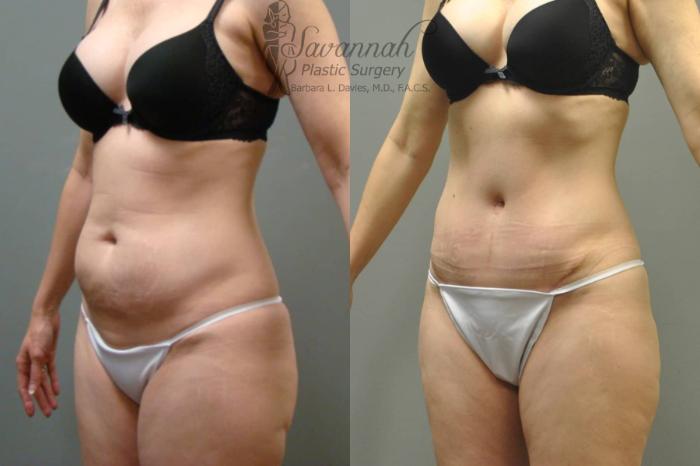 Before & After Tummy Tuck Case 36 View 2 View in Savannah, Georgia
