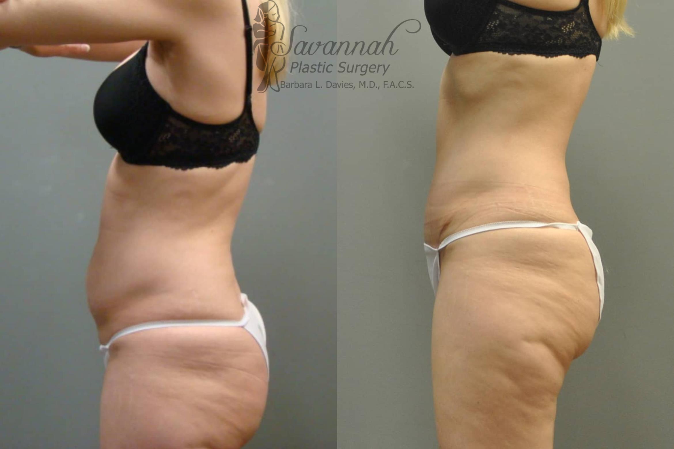 Before & After Tummy Tuck Case 36 View 3 View in Savannah, Georgia