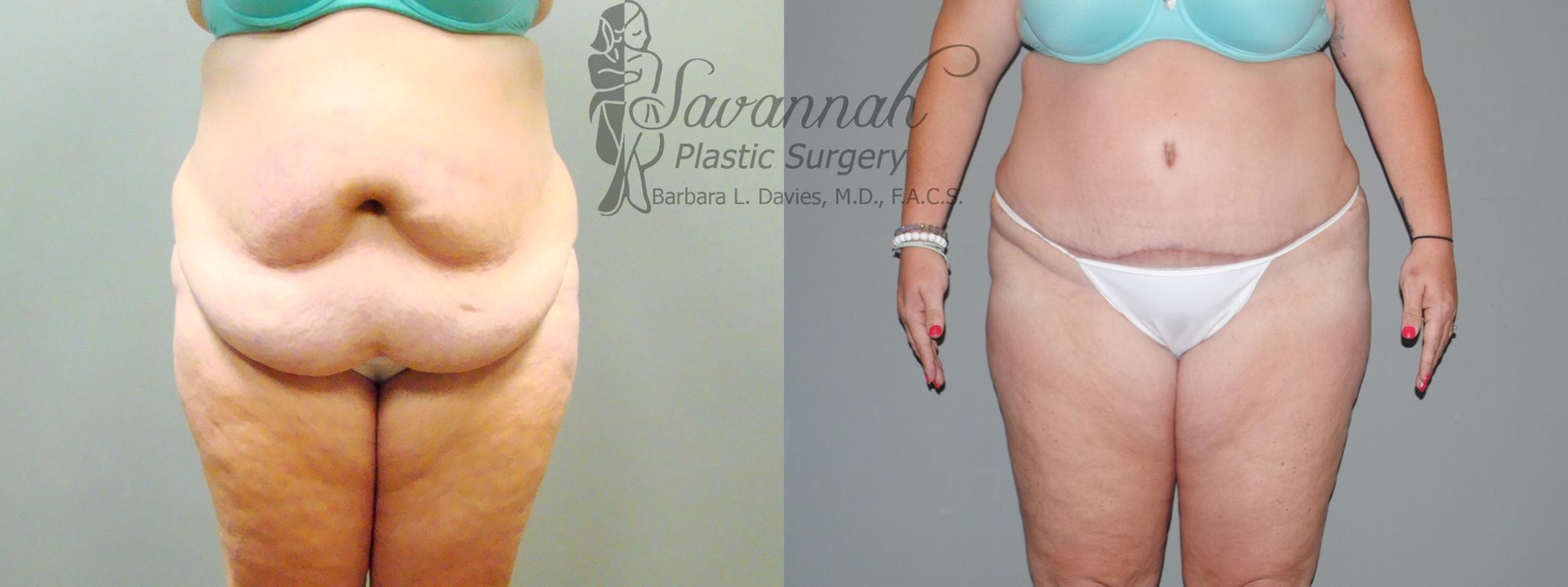 Before & After Tummy Tuck Case 37 View 1 View in Savannah, Georgia