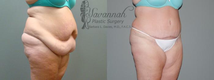 Before & After Tummy Tuck Case 37 View 2 View in Savannah, Georgia