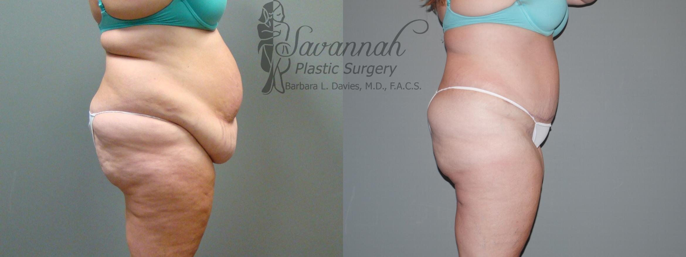 Before & After Tummy Tuck Case 37 View 3 View in Savannah, Georgia