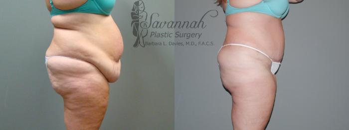 Before & After Tummy Tuck Case 37 View 3 View in Savannah, Georgia