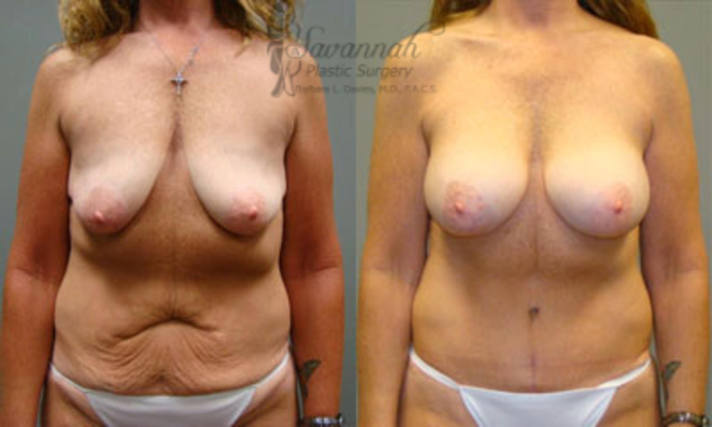 Before & After Tummy Tuck Case 39 View 1 View in Savannah, Georgia