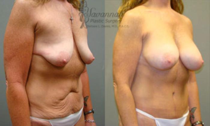 Before & After Tummy Tuck Case 39 View 2 View in Savannah, Georgia